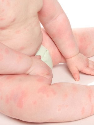 BABIES WITH HIVES