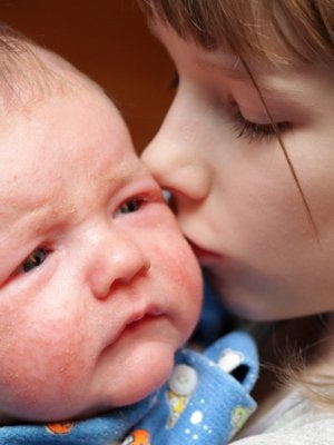 Cmpa Symptom Eczema In Babies Nestle Health Science